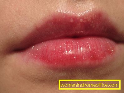 Bele pike na ustnicah pod kožo - kaj je to?