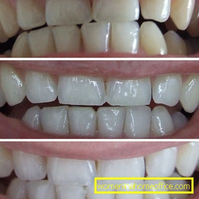 Prednosti in slabosti beljenja zob s trakovi